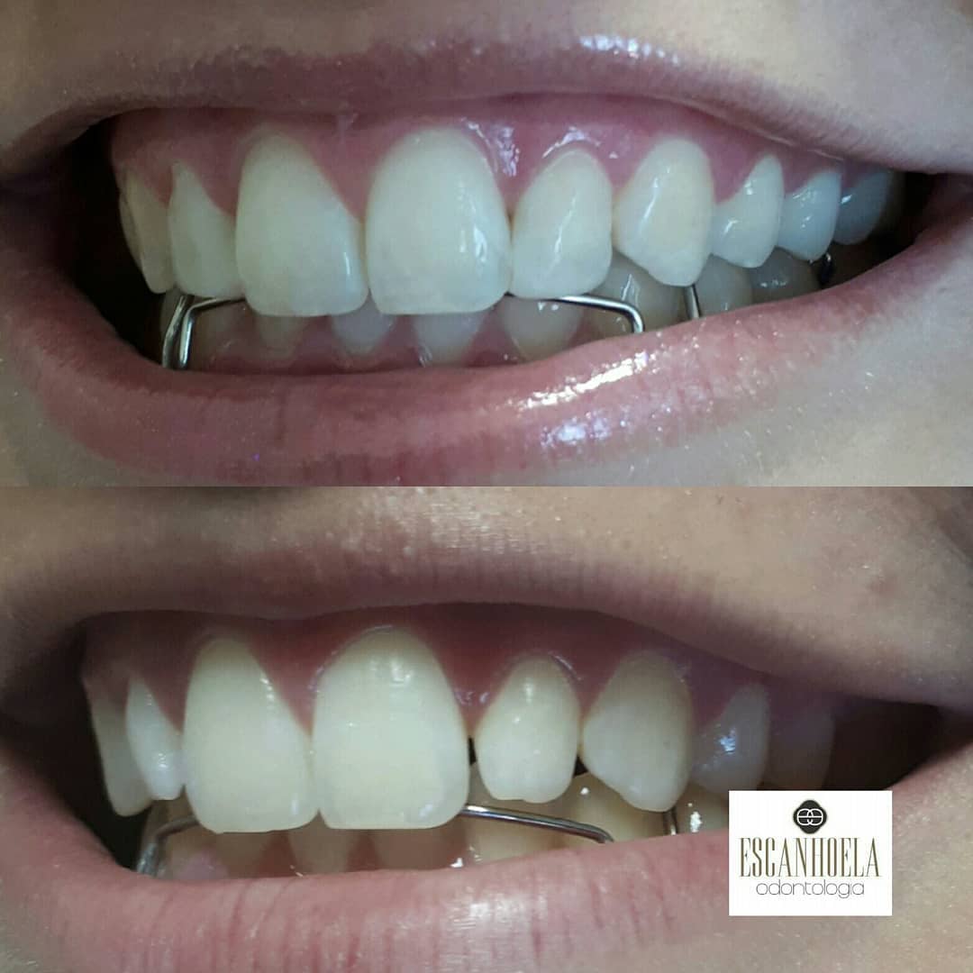 Alinhamento do Sorriso — antes e depois